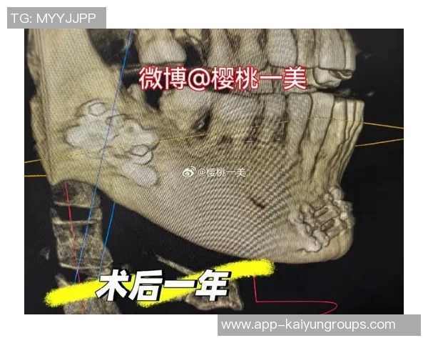 米兰官方宣布奇克下颌骨骨折手术成功预计缺阵八周 米兰官方宣布奇克下颌骨骨折手术成功预计缺阵八周